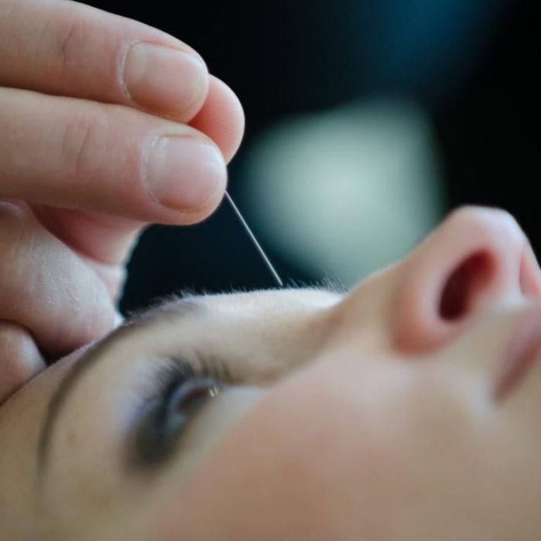 kozmetična akupunktura pomlajevanje obraza s tradicionalno kitajsko medicino