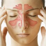 sinusitis zdravljenje s tradicionalno kitajsko medicino