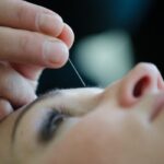 kozmetična akupunktura pomlajevanje obraza s tradicionalno kitajsko medicino