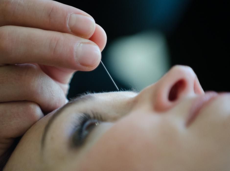 kozmetična akupunktura pomlajevanje obraza s tradicionalno kitajsko medicino